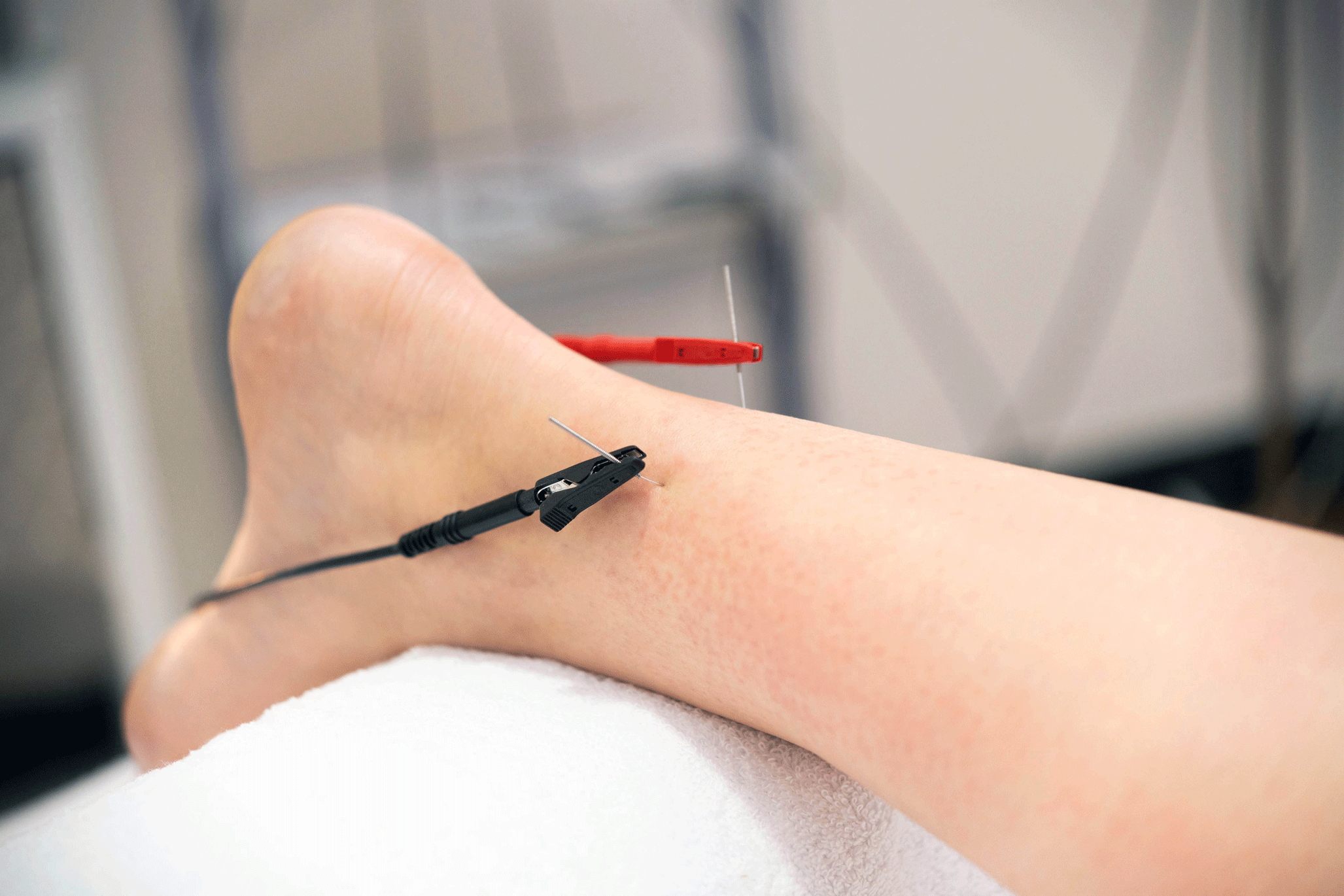 Dry Needling → depositphotos 358759150 xl
